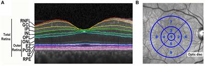 Persistent and Progressive Outer Retina Thinning in Frontotemporal Degeneration